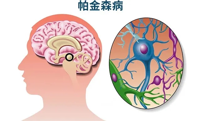 PD研究必读：帕金森病症状表现及传播机制全